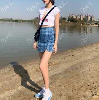 新疆黎美大腿吸脂術(shù)后一個月 新疆黎美大腿吸脂術(shù)后一個月