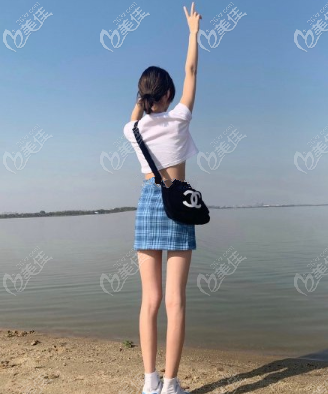 可喜可賀：我在新疆黎美做完大腿吸脂3個月沒爆腫也沒反彈，腿還直了