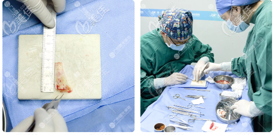 廣州曙光王旭明鼻子修復之肋軟骨雕刻過程圖