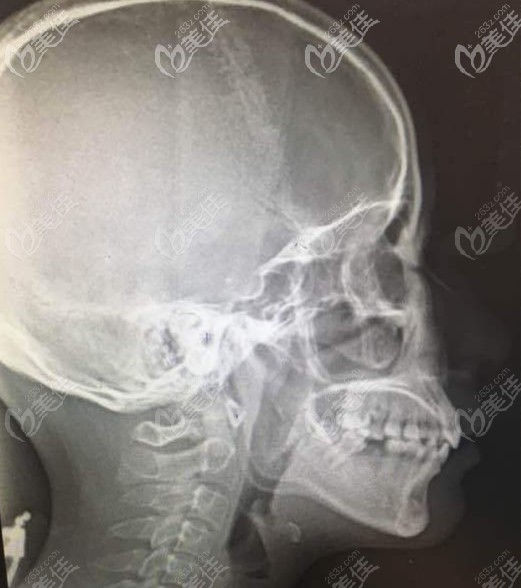 2級骨性齙牙的頭顱片 2級骨性齙牙的頭顱片