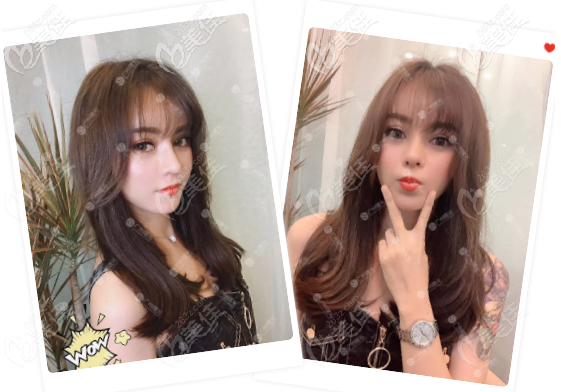 廣州曙光王旭明鼻修復案例圖片一個月效果圖