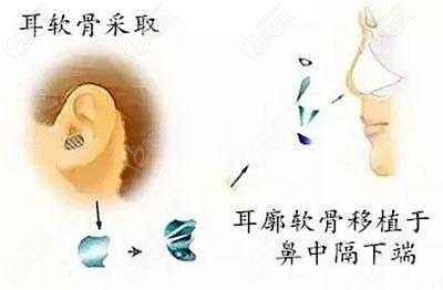 自體耳軟骨隆鼻材料
