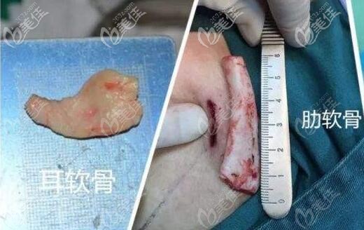 耳軟骨隆鼻和肋骨隆鼻材料的對比