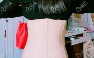 在漢中仁愛韓美做腰部吸脂術(shù)后第10天 在漢中仁愛韓美做腰部吸脂術(shù)后第10天