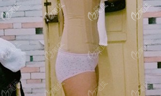 在漢中仁愛韓美做腰部吸脂術(shù)后第20天 在漢中仁愛韓美做腰部吸脂術(shù)后第20天