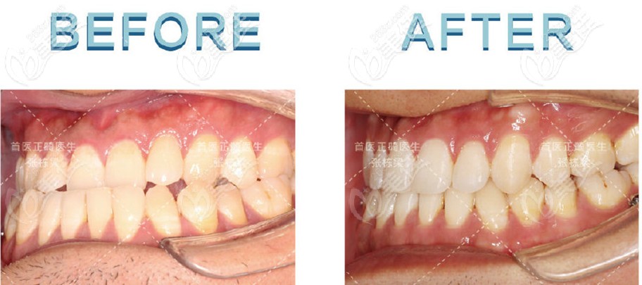 地包天用舌側(cè)隱形矯正牙齒的改善情況