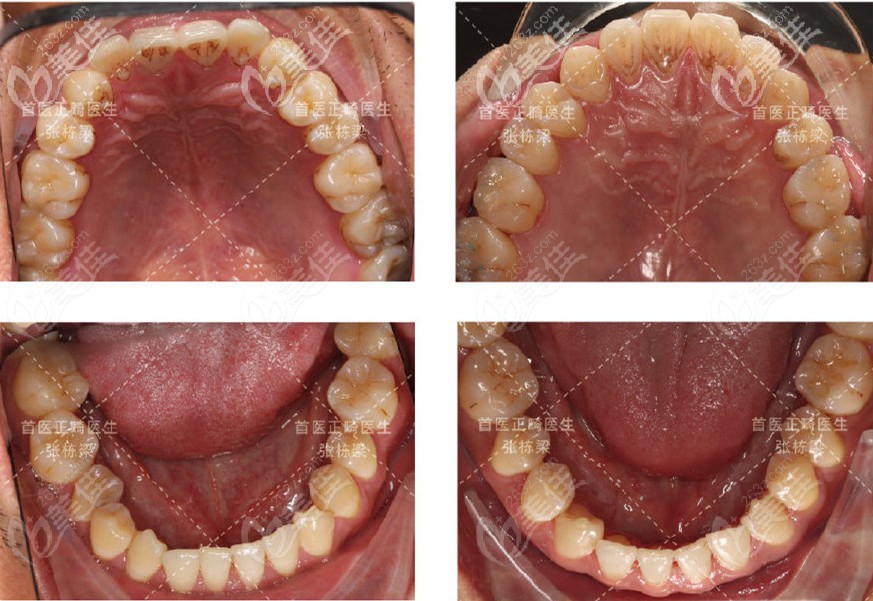 上下頜牙齒都有所改善，且沒有牙齒出現(xiàn)脫礦的情況
