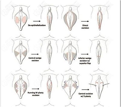 陰唇縮小手術的不同方法