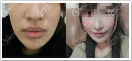 我做手術(shù)微笑唇恢復(fù)半年前后對比照