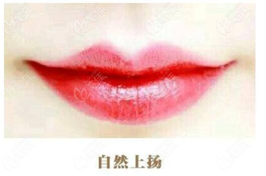 微笑唇效果圖片