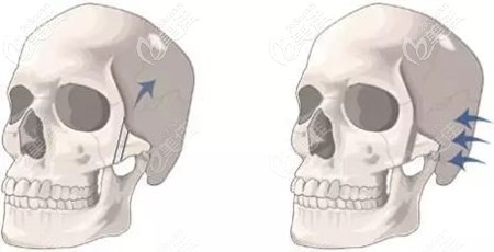 磨骨手術(shù)過(guò)程 磨骨手術(shù)過(guò)程