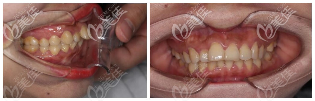 北京牙管家牙列擁擠案例 北京牙管家牙列擁擠案例