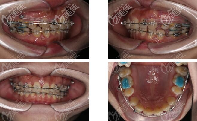 全口mbt直絲弓矯正圖片 全口mbt直絲弓矯正圖片