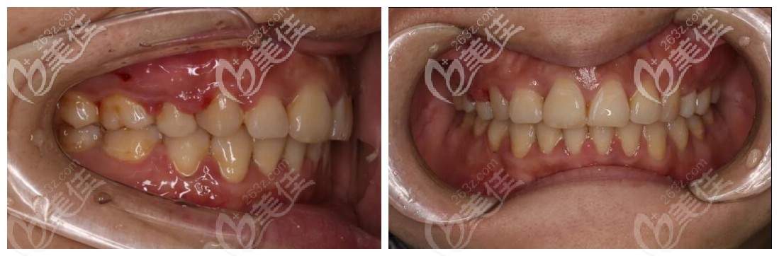 北京牙管家口腔的美國mbt直絲弓矯治案例,內(nèi)附矯正費(fèi)用