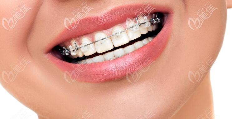 陶瓷mbt半隱形牙齒矯正圖 陶瓷mbt半隱形牙齒矯正圖