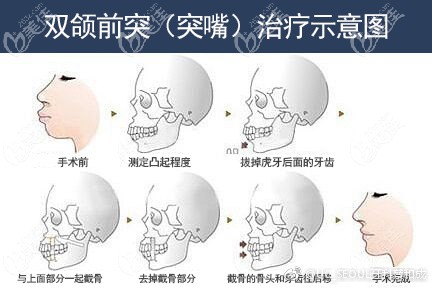 雙頜前突矯正示意圖告訴你雙頜前突怎么矯正