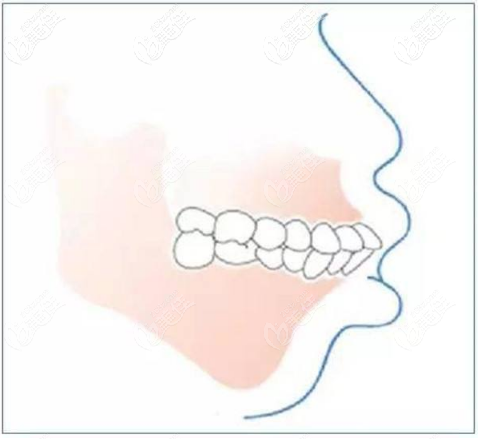 骨性雙頜前突示意圖