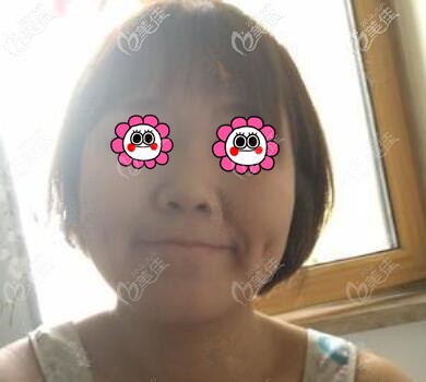 做鼻綜合術(shù)前照 做鼻綜合術(shù)前照