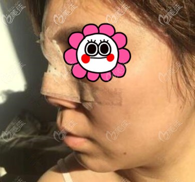 鼻整形術(shù)后第2天情況 鼻整形術(shù)后第2天情況