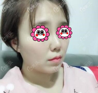 做鼻整形半個(gè)月的恢復(fù)效果照 做鼻整形半個(gè)月的恢復(fù)效果照