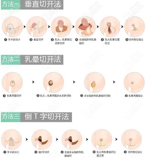 縮胸手術(shù)細節(jié) 縮胸手術(shù)細節(jié)