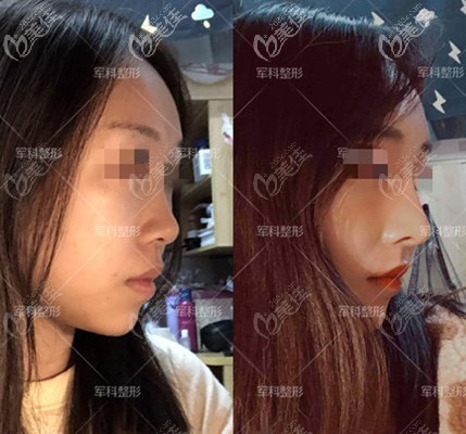 重慶軍科醫(yī)院鼻綜合案例