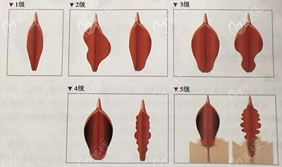 陰唇肥大的輕重程度
