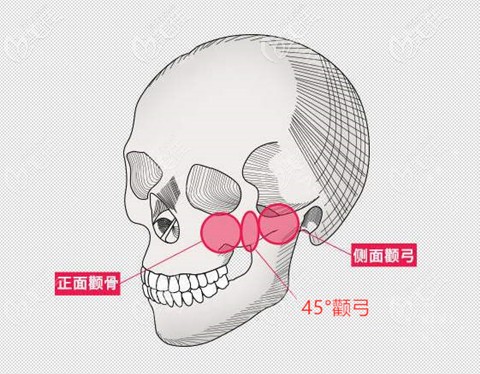 顴骨顴弓決定磨顴骨還是顴骨內(nèi)推 顴骨顴弓決定磨顴骨還是顴骨內(nèi)推