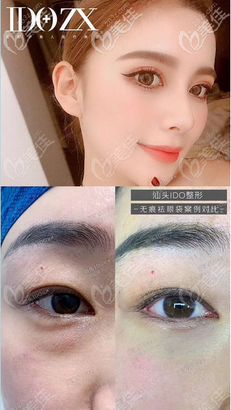 汕頭愛都滬美人不愧是汕頭網(wǎng)紅整形醫(yī)院,張賢期醫(yī)生做的雙眼皮祛眼袋效果超好看