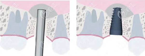 上頜竇內(nèi)外提升術(shù)的區(qū)別 上頜竇內(nèi)外提升術(shù)的區(qū)別