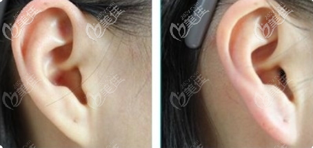 我做的玻尿酸豐耳垂的前后對比效果展示