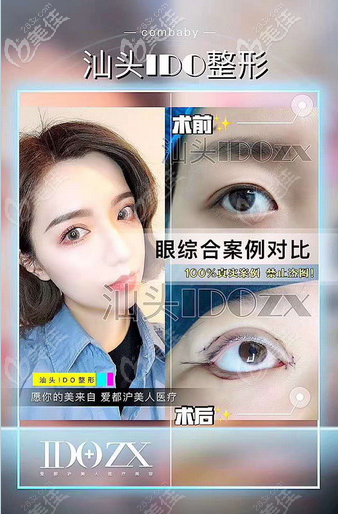 看汕頭愛都滬美人張賢期醫(yī)生做雙眼皮怎么樣 看汕頭愛都滬美人張賢期醫(yī)生做雙眼皮怎么樣