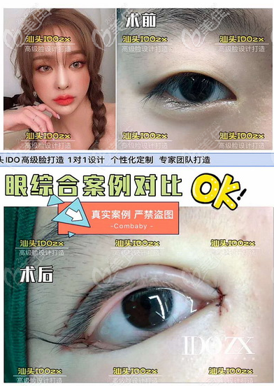 汕頭愛都滬美人雙眼皮案例 汕頭愛都滬美人雙眼皮案例