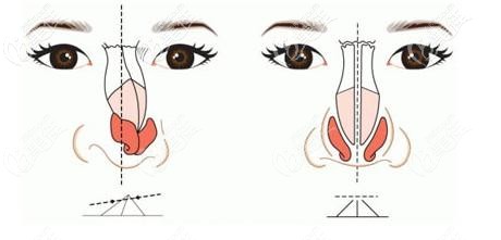 假體隆鼻歪斜修復手術 假體隆鼻歪斜修復手術