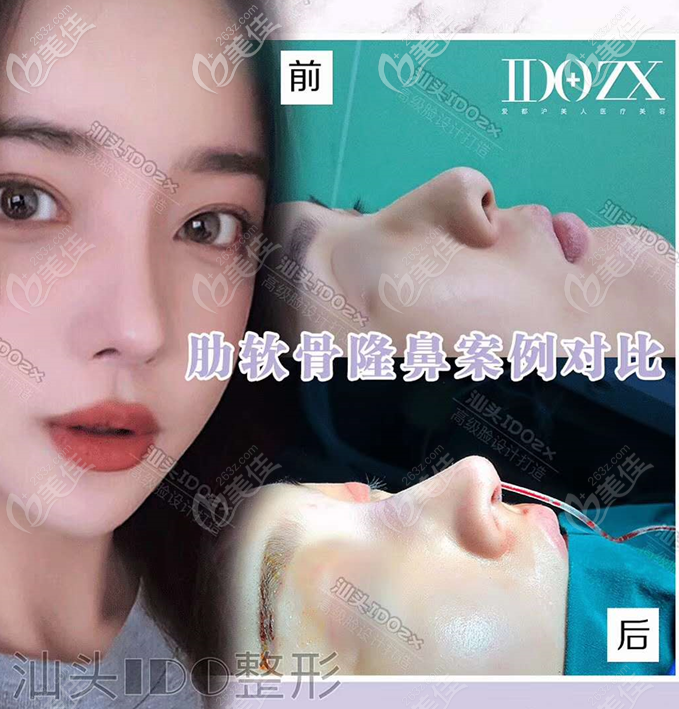 汕頭愛都滬美人張賢期醫(yī)生隆鼻案例 汕頭愛都滬美人張賢期醫(yī)生隆鼻案例