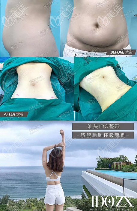 汕頭愛都滬美人張賢期醫(yī)生吸脂手術(shù)案例 汕頭愛都滬美人張賢期醫(yī)生吸脂手術(shù)案例