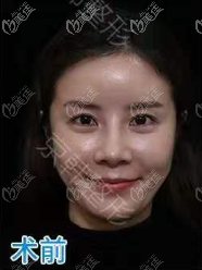 在北京京韓做維密6度脂雕面部修復(fù)前樣子 在北京京韓做維密6度脂雕面部修復(fù)前樣子