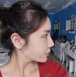 做維密6度面部脂肪填充失敗修復(fù)第8天 做維密6度面部脂肪填充失敗修復(fù)第8天