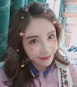 找喬愛軍做維密6度脂雕面部脂肪填充過多修復(fù)有一個多月了 找喬愛軍做維密6度脂雕面部脂肪填充過多修復(fù)有一個多月了