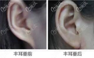 玻尿酸豐耳垂前后對比照