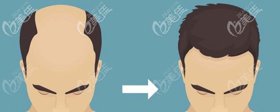 植發(fā)手術(shù)的發(fā)展史