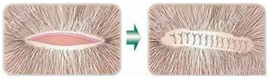 早期的FUT毛發(fā)移植技術(shù)