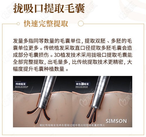 3D植發(fā)技術(shù)使用隴吸口的優(yōu)勢