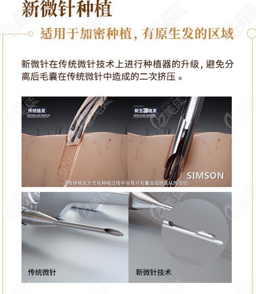 3D植發(fā)技術(shù)使用新微針跟微針植發(fā)的區(qū)別