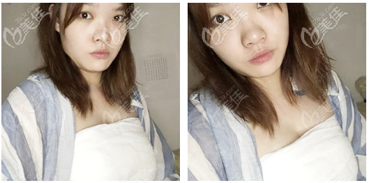 韓妃牟北平隆胸術(shù)后三天 韓妃牟北平隆胸術(shù)后三天