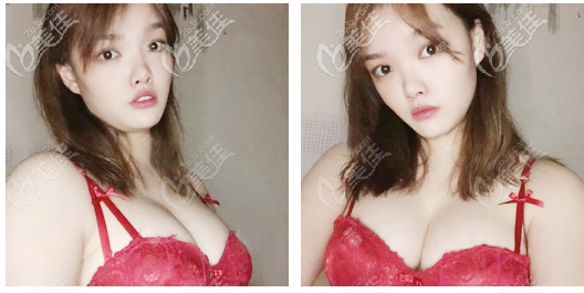 韓妃牟北平隆胸7天<span style= 韓妃牟北平隆胸7天<span style=