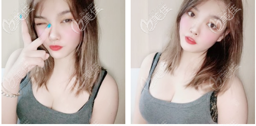 韓妃牟北平隆胸技術(shù)真的很贊 韓妃牟北平隆胸技術(shù)真的很贊