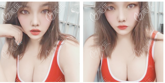 找韓妃牟北平醫(yī)生做完隆胸半年了,效果很滿(mǎn)意