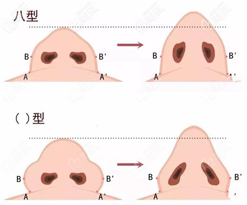 鼻翼肥大的類型