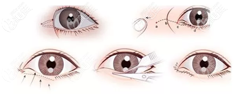 開眼角手術(shù)過程 開眼角手術(shù)過程